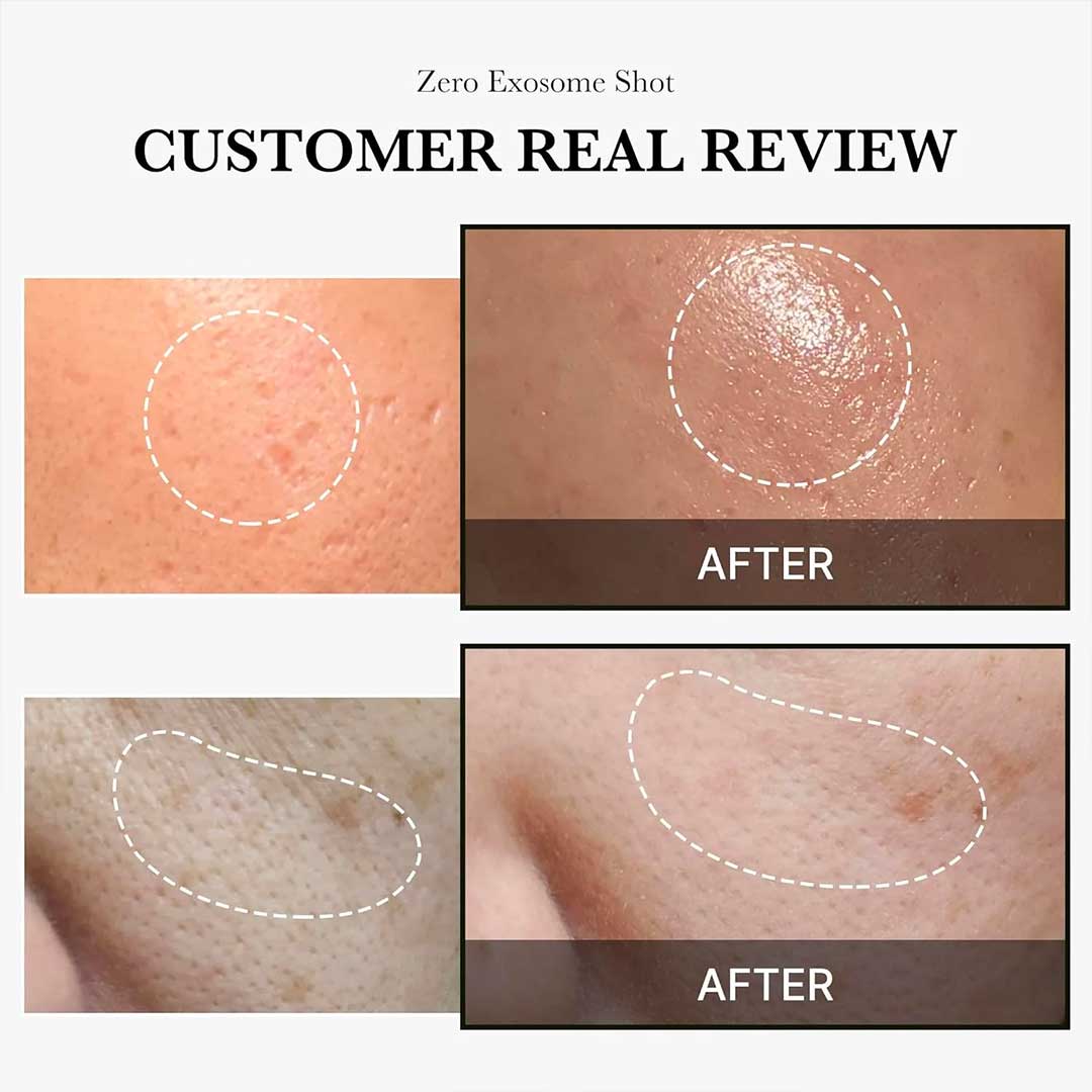 Medicube One Day Exosome Shot 2000 Siero rivitalizzante con microaghi 30 ml