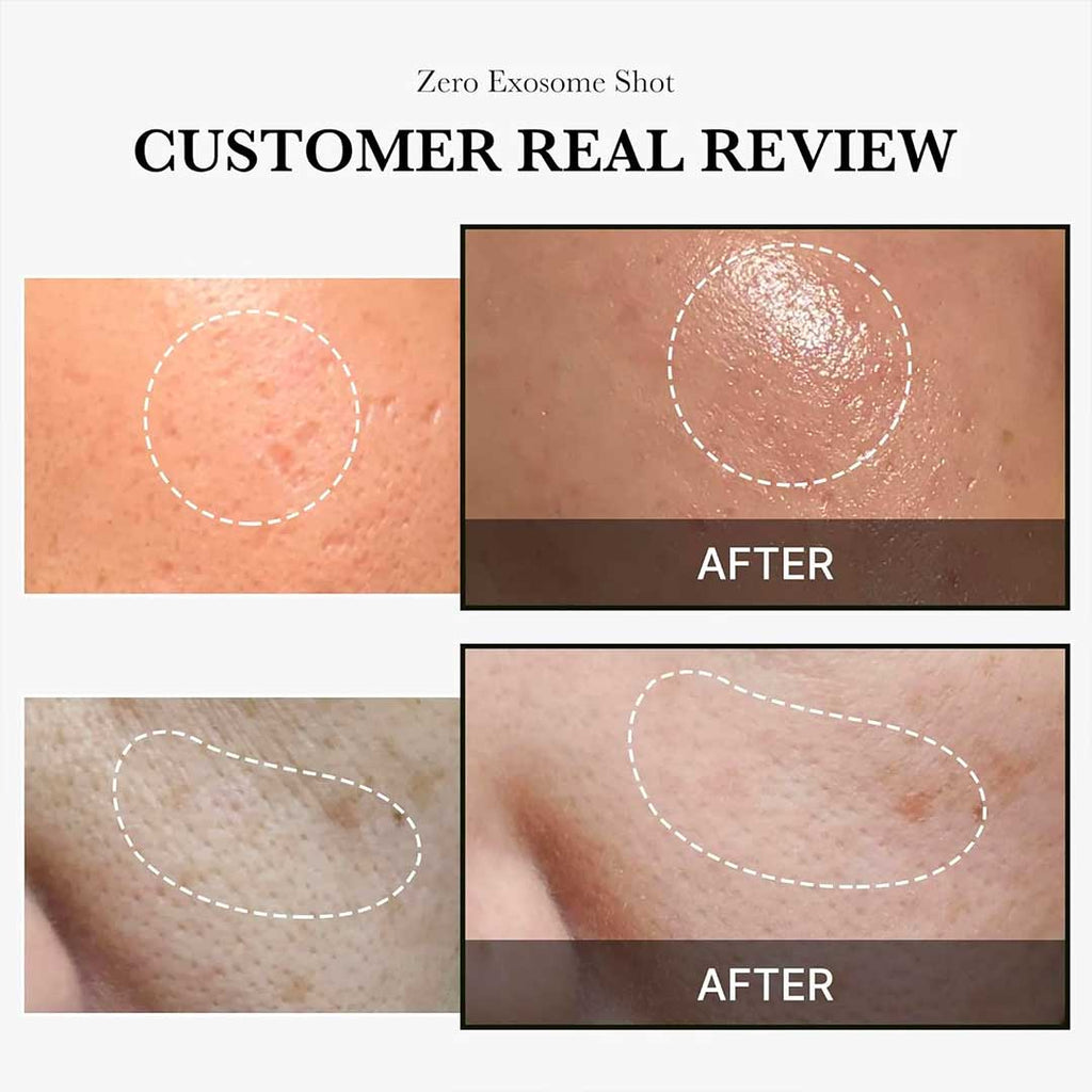 Medicube One Day Exosome Shot 2000 Siero rivitalizzante con microaghi 30 ml